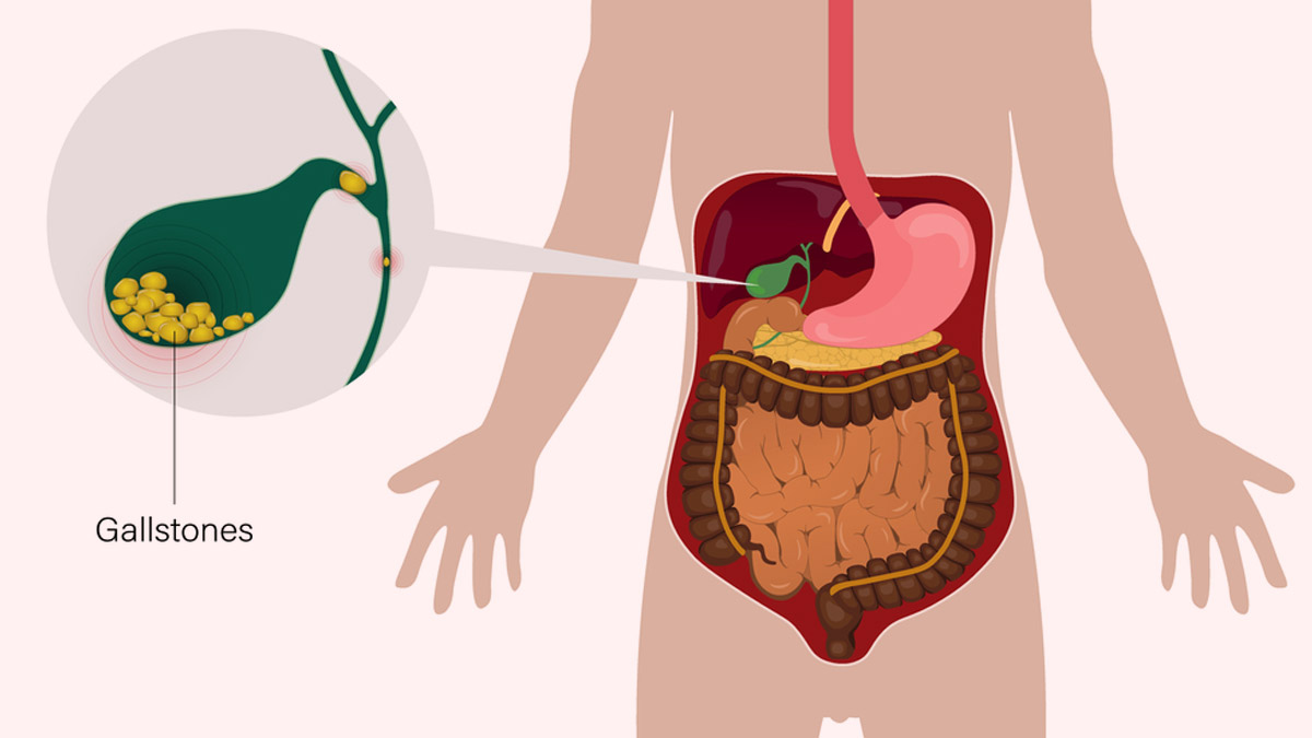 What Are Gallbladder Stones? Understanding Signs, Causes, And treatment