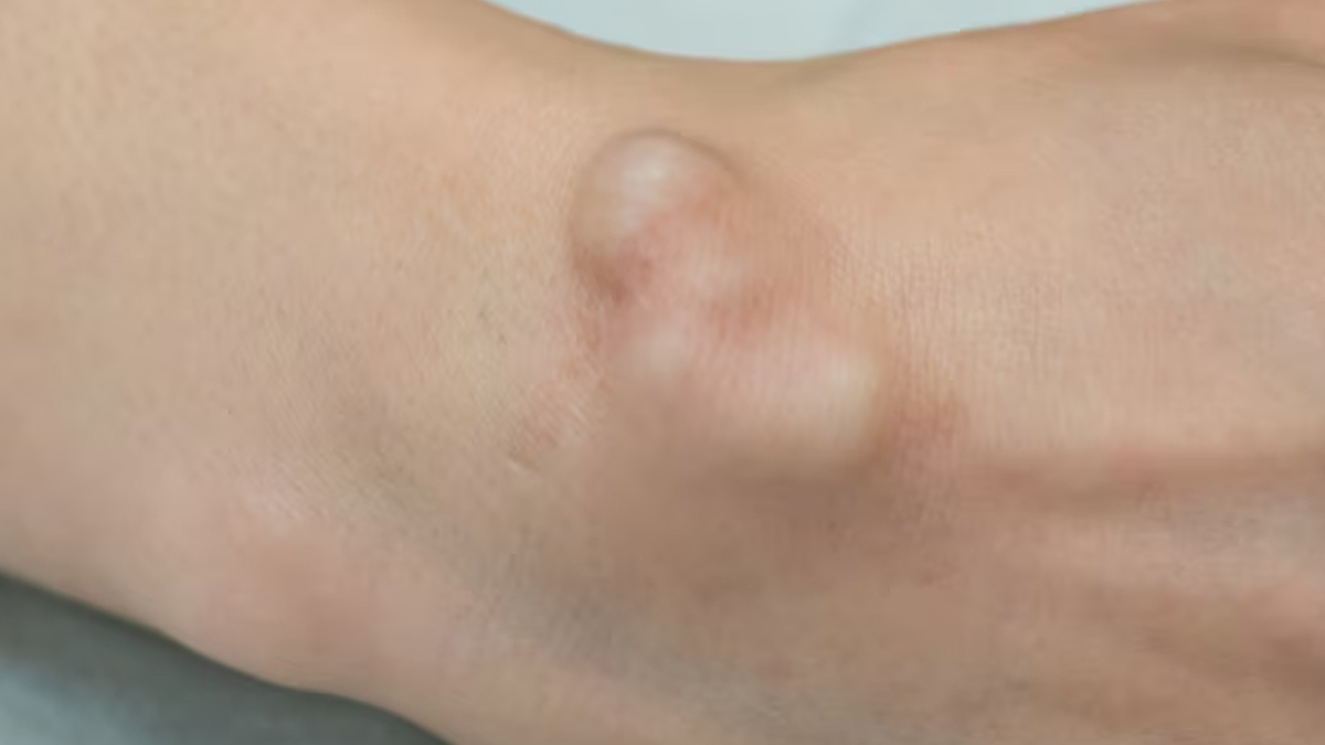 Causes Of Sebaceous Cyst In Hindi 