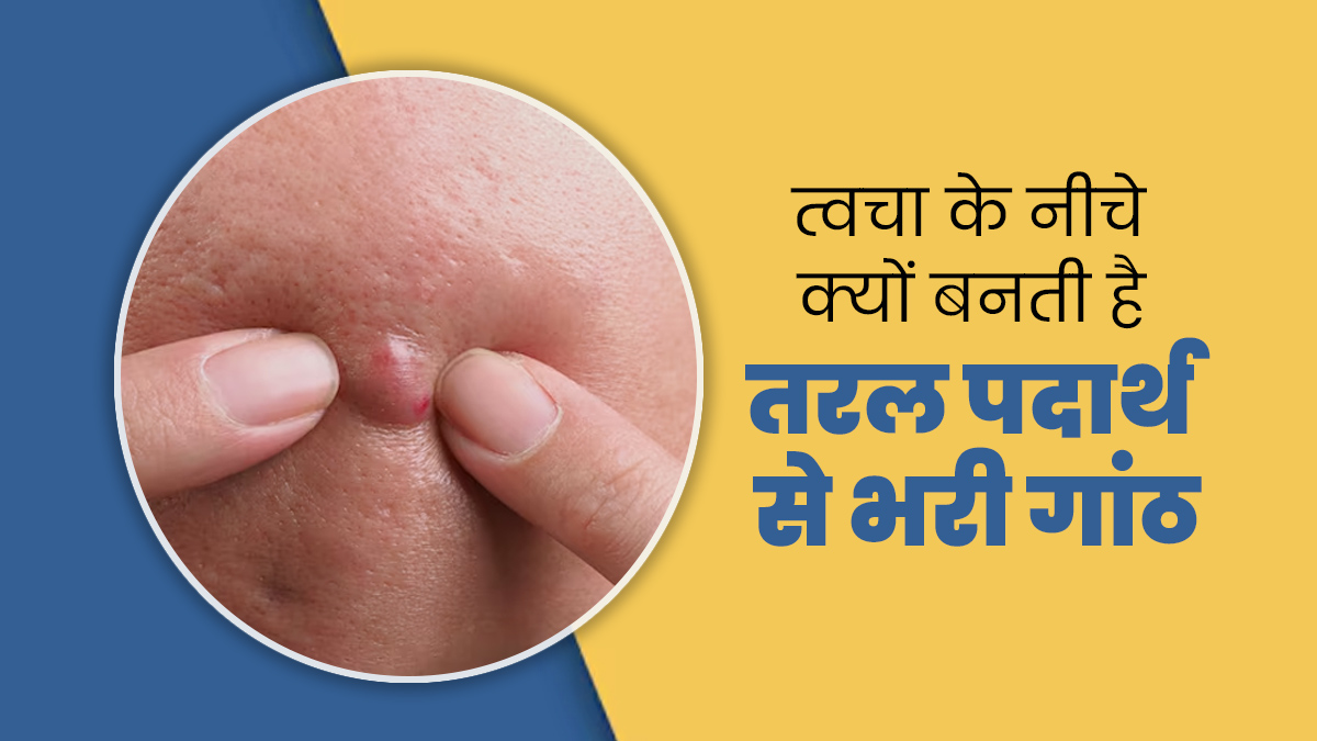 त्वचा के नीचे क्यों बनती है तरल पदार्थ से भरी गांठ, जानें इसके कारण और इलाज का तरीका
