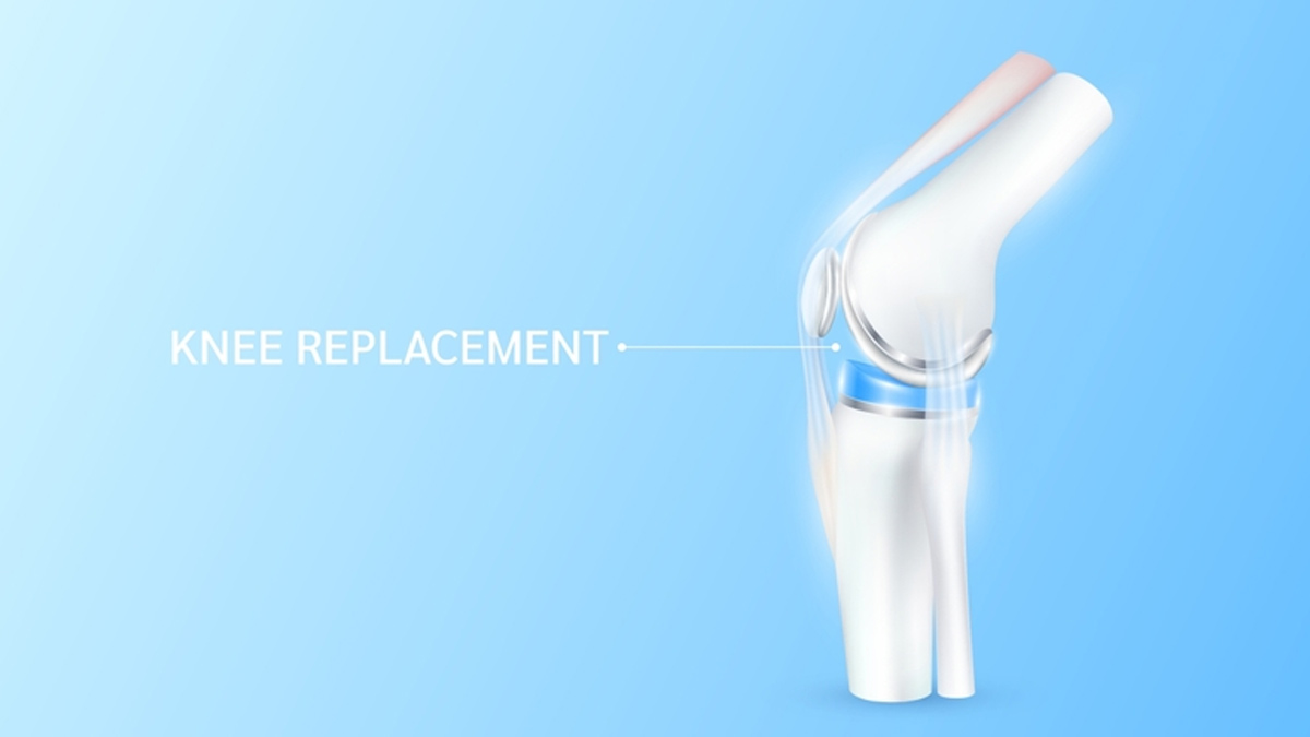 Don't Wait On Knee Replacement: Expert Explains Why Delay Can Worsen Your Pain