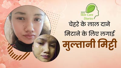 चेहरे पर एलर्जी की वजह से हो गए थे छोटे-छोटे लाल दाने, छुटकारा पाने के लिए मैंने लगाई मुल्तानी मिट्टी