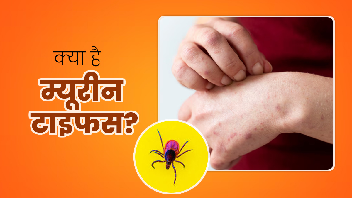 पिस्सू के काटने से फैलता है म्यूरीन टाइफस, जानें इस दुर्लभ बैक्‍टीर‍ियल रोग के लक्षण, कारण और इलाज