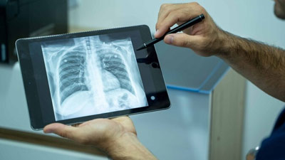 अब भारत में आसानी से होगी टीबी की जांच, ICMR ने बनाई हाथ से चलने वाली एक्स-रे मशीन