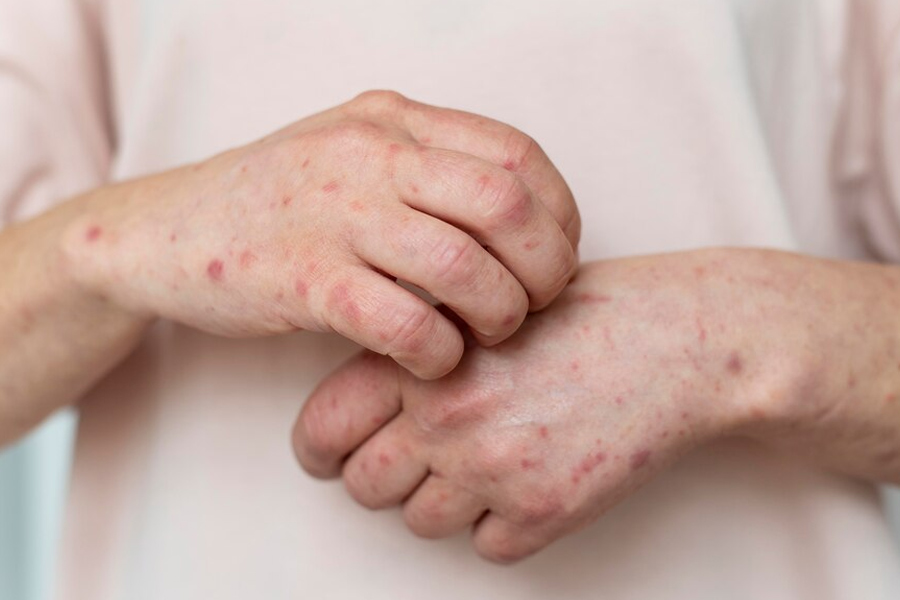 atopic-dermatitis