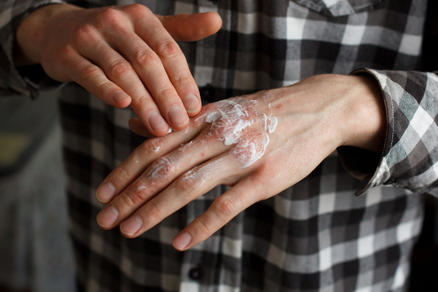 emollients-for-eczema