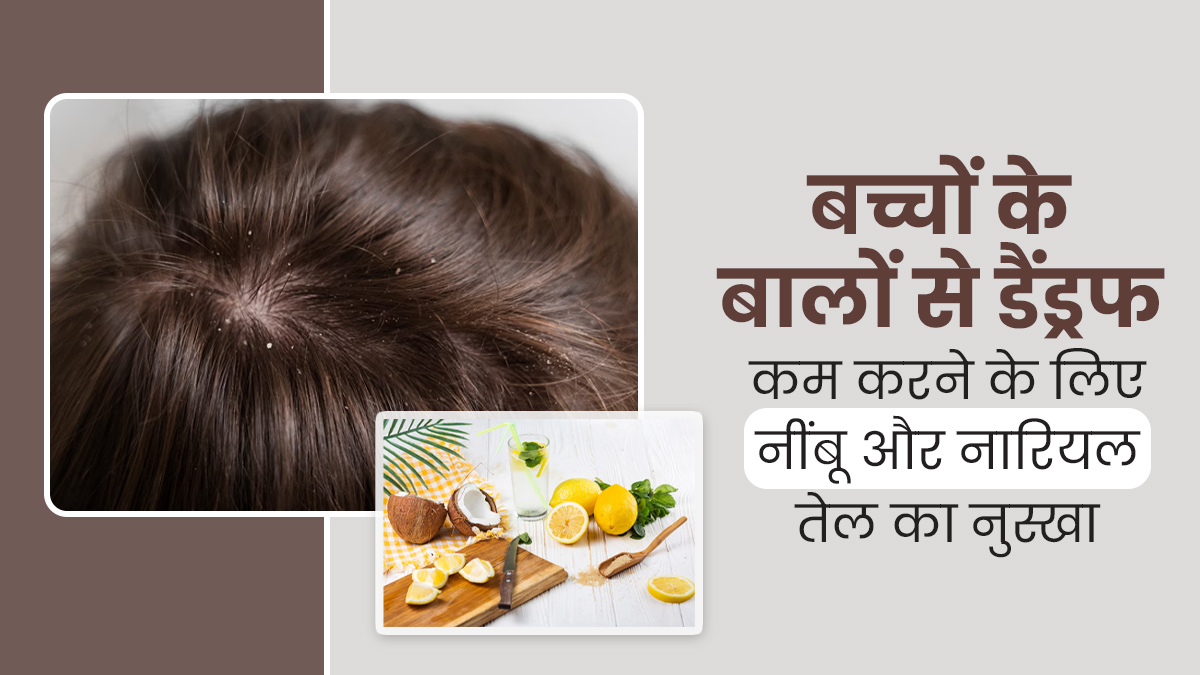 बच्चों के बालों में डैंड्रफ से हैं परेशान तो इस्तेमाल करें जावेद हबीब के बताया ये नुस्खा, जल्द दिखेगा असर