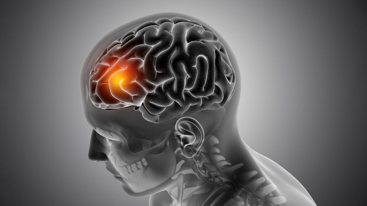 Common Misconceptions About Strokes