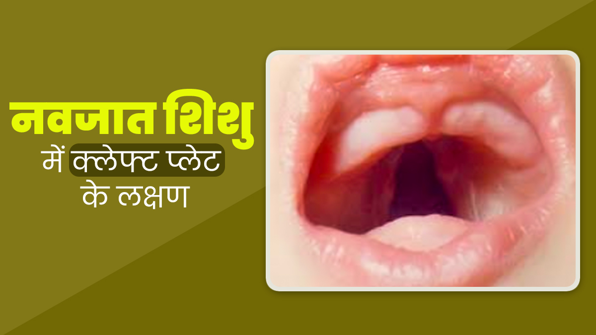 Cleft Palate: इस समस्या के कारण बार-बार मुंह से दूध निकालता है नवजात शिशु, जानें इसके लक्षण और इलाज