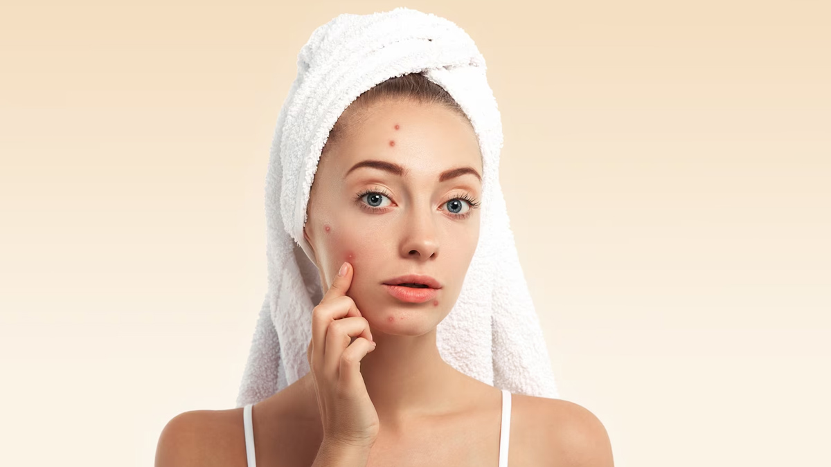 hormonal acne