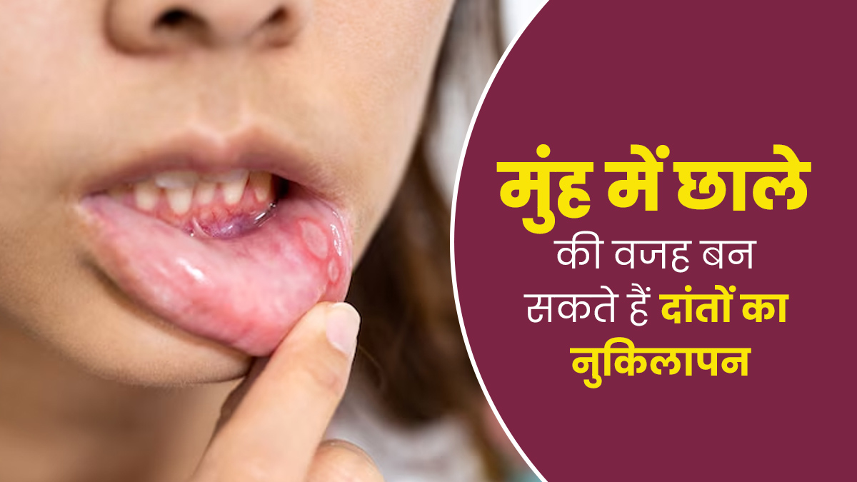 लंबे और नुकीले दांत बन सकते हैं मुंह में छालों का कारण, जानें कैसे करें बचाव