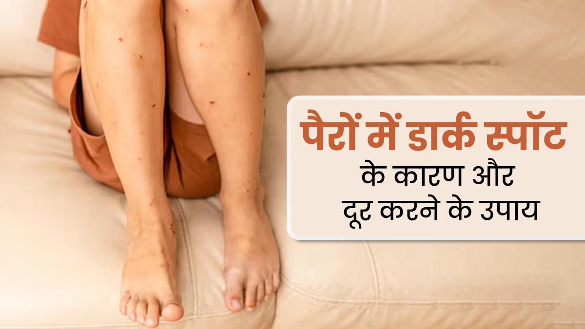 पैरों में डार्क स्पॉट्स होने के पीछे हो सकते हैं ये 5 कारण, जानें इसे दूर करने के उपाय 