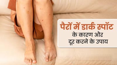 पैरों में डार्क स्पॉट्स होने के पीछे हो सकते हैं ये 5 कारण, जानें इसे दूर करने के उपाय 