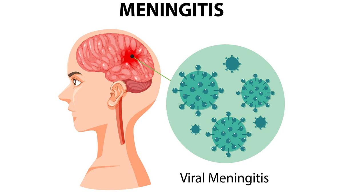 Difference Between Meningitis And Encephalitis Symptoms In Hindi
