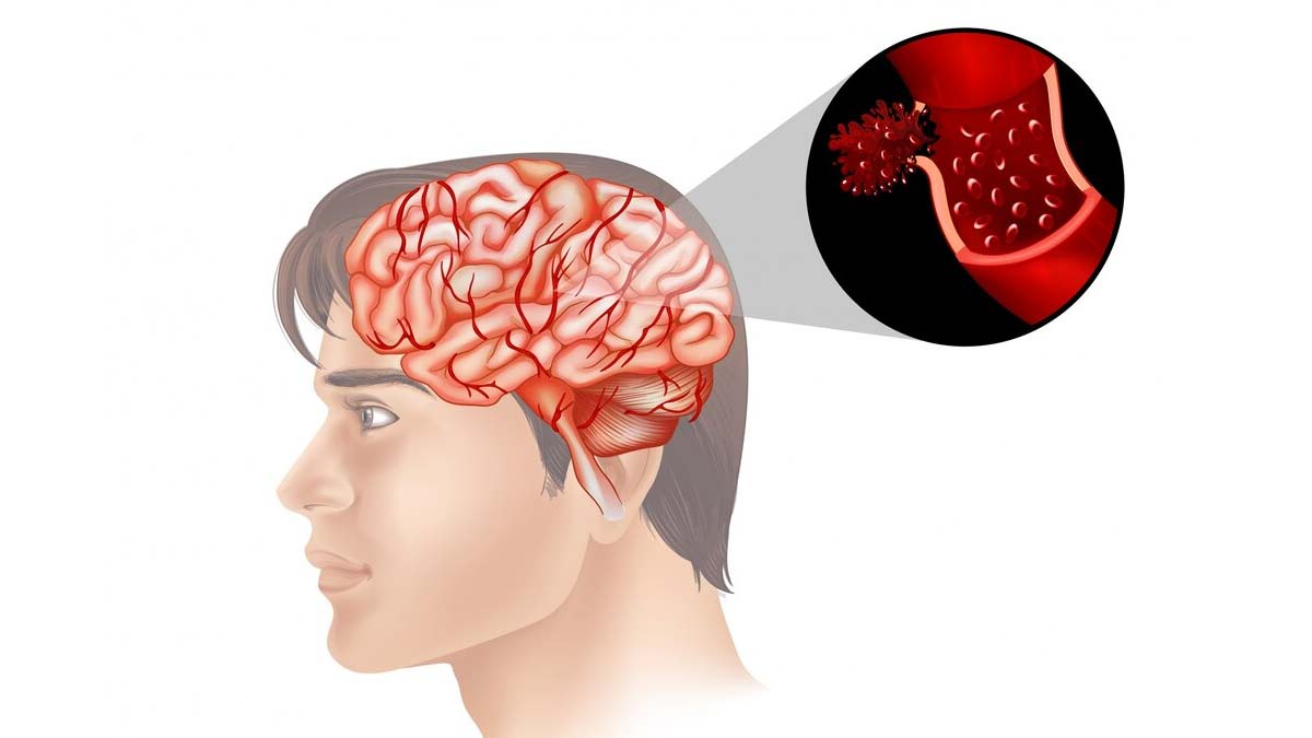 Difference Between Meningitis And Encephalitis Symptoms In Hindi