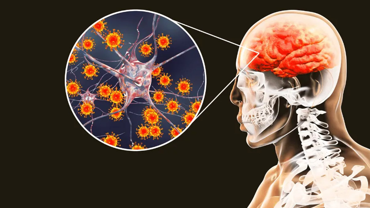 encephalitis in hindi