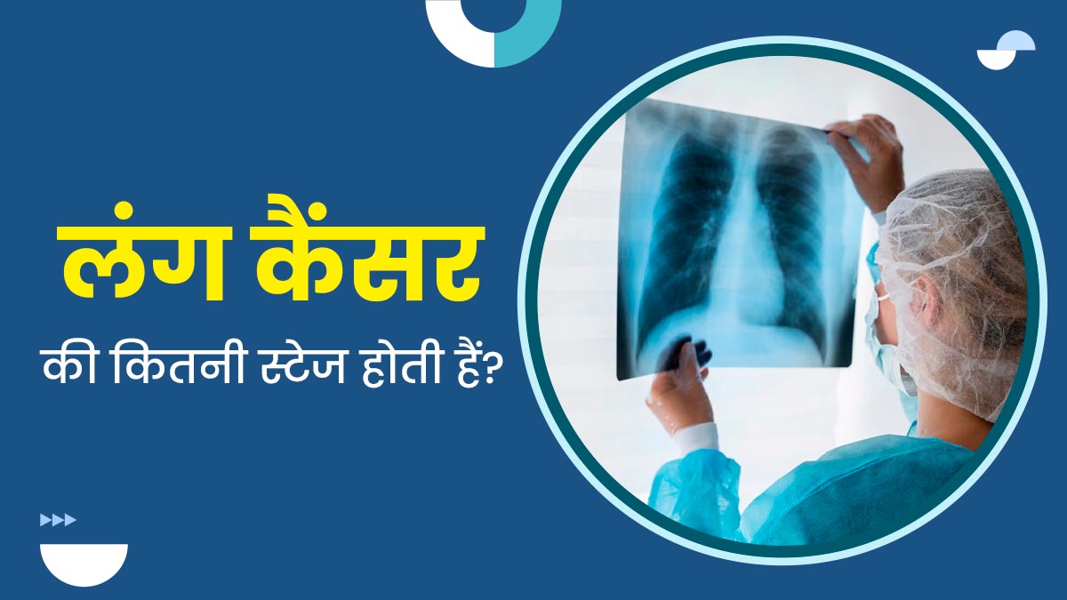 लंग कैंसर के कितने स्टेज होते हैं? जानें कौन-सा चरण होता है ज्यादा गंभीर