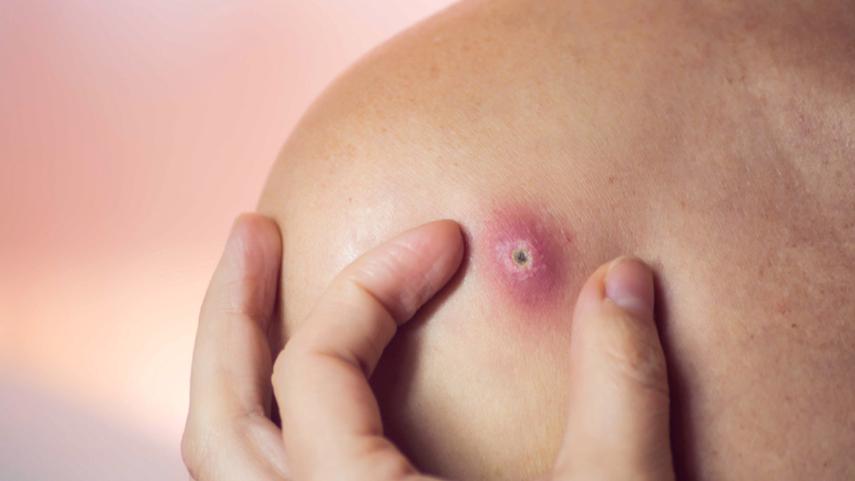 Painful, Pus-Filled Bumps? Expert Explains Carbuncles, Causes, Signs, And Treatment | OnlyMyHealth