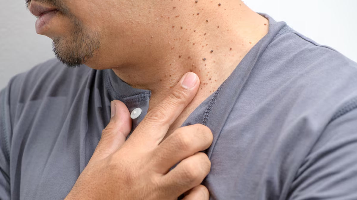Why Some People Develop Skin Tags On Their Neck