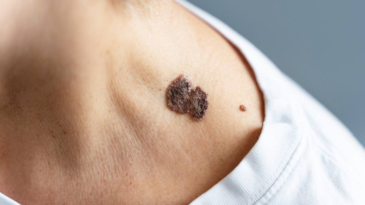 Causes Of Wart