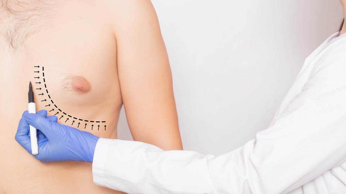 What Men Need To Know About Enlarged Breast Tissue: Is It Worrisome?