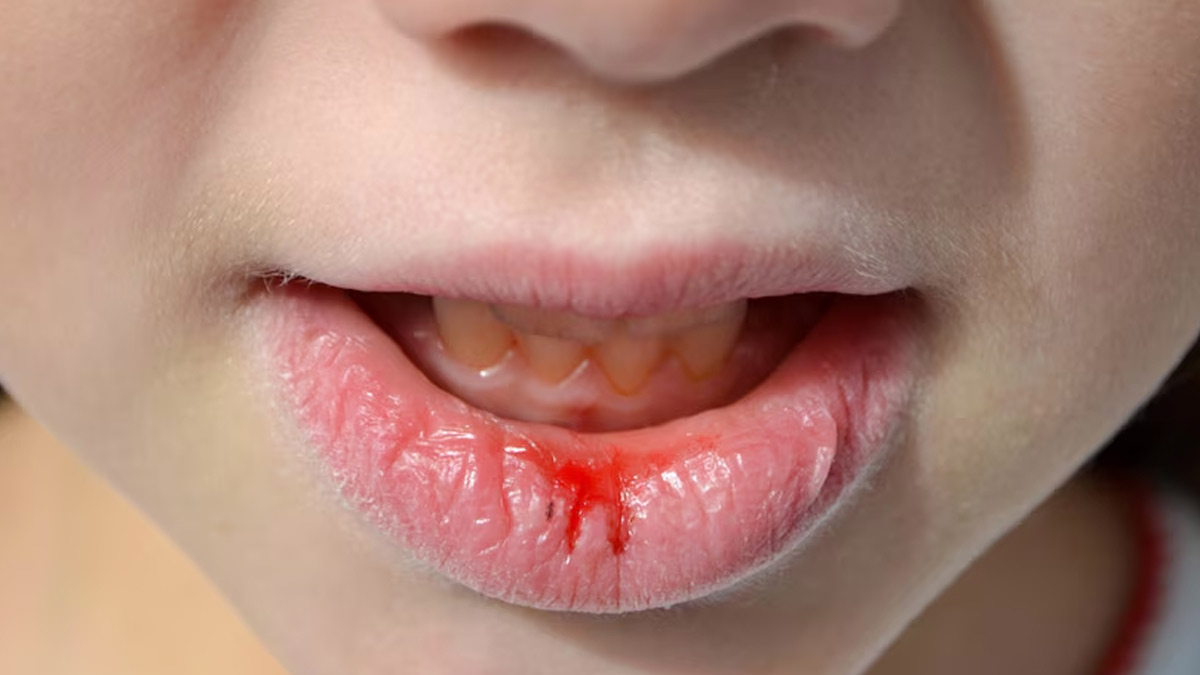 What is Lip Cancer? Understanding Signs, Causes, and Treatment 