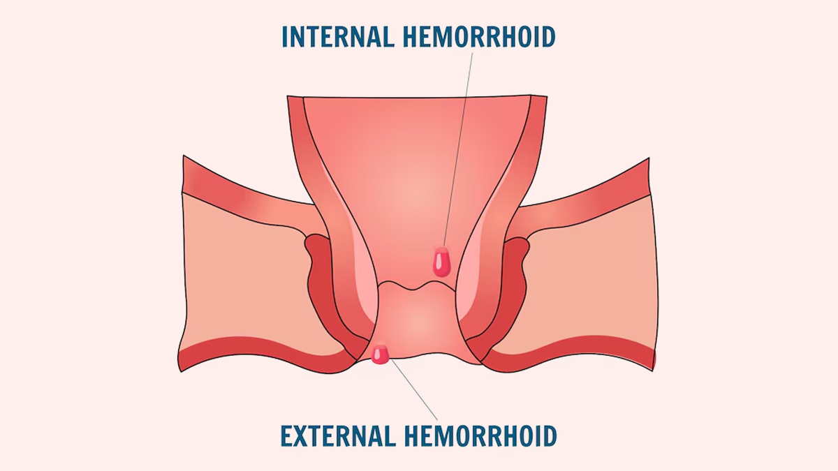 Haemorrhoids