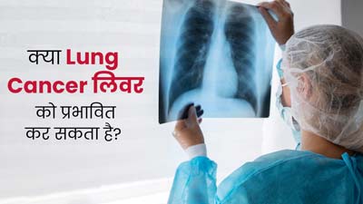 क्या फेफड़ों के कैंसर से लिवर प्रभावित होता है? एक्सपर्ट से जानें दोनों में संबंध