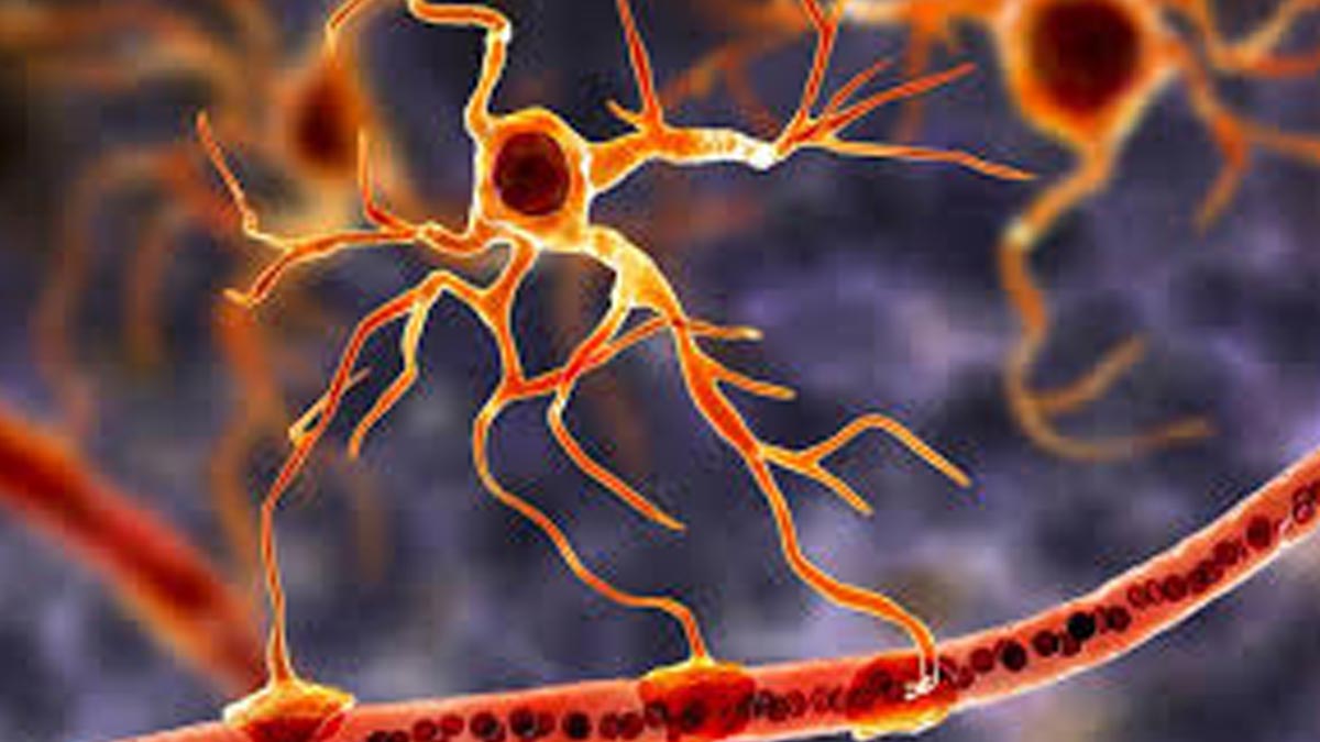 Study Discovers New Gene Linked to Huntington's Disease Progression 