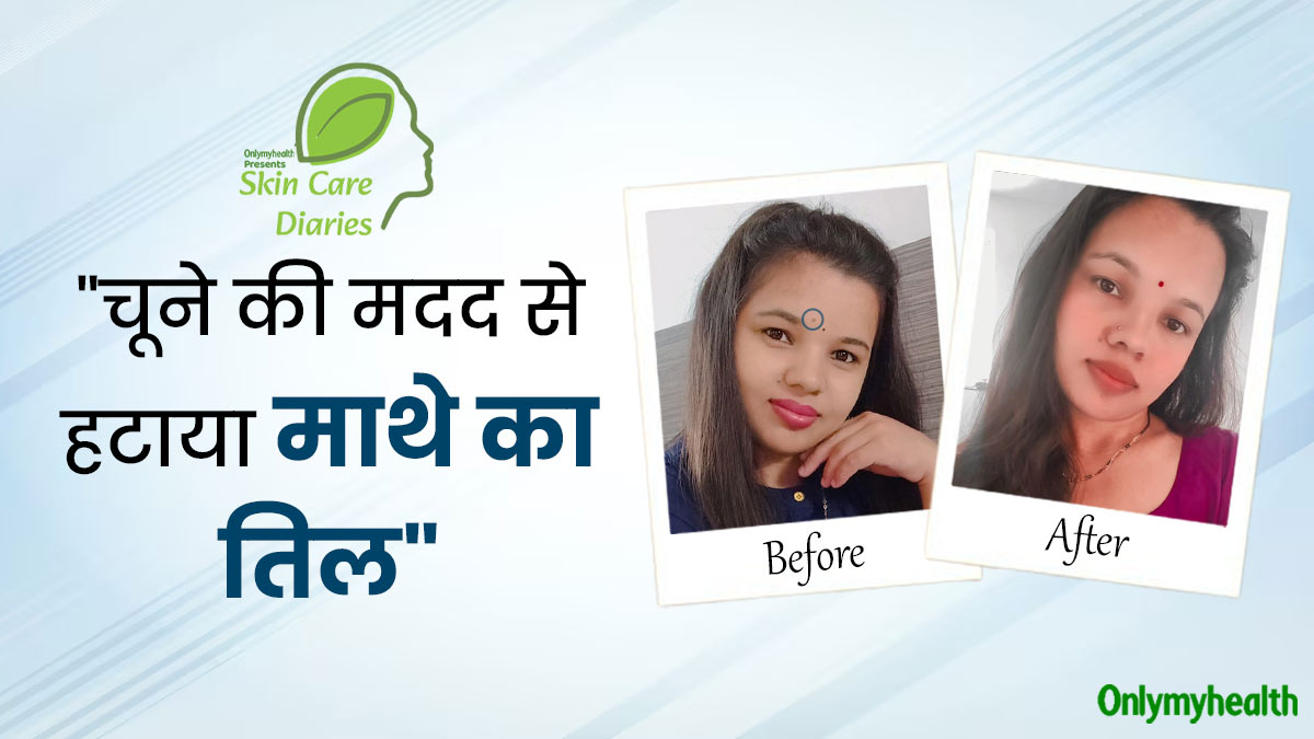 संगीता ने चूने की मदद से हटाया माथे का तिल, डॉक्टर से जानें वाकई यह उपाय कारगर है या नहीं?