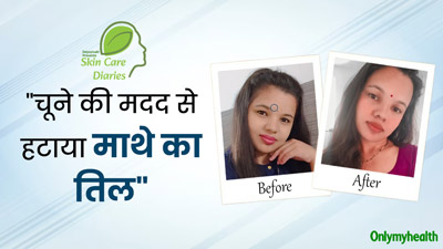 संगीता ने चूने की मदद से हटाया माथे का तिल, डॉक्टर से जानें वाकई यह उपाय कारगर है या नहीं?