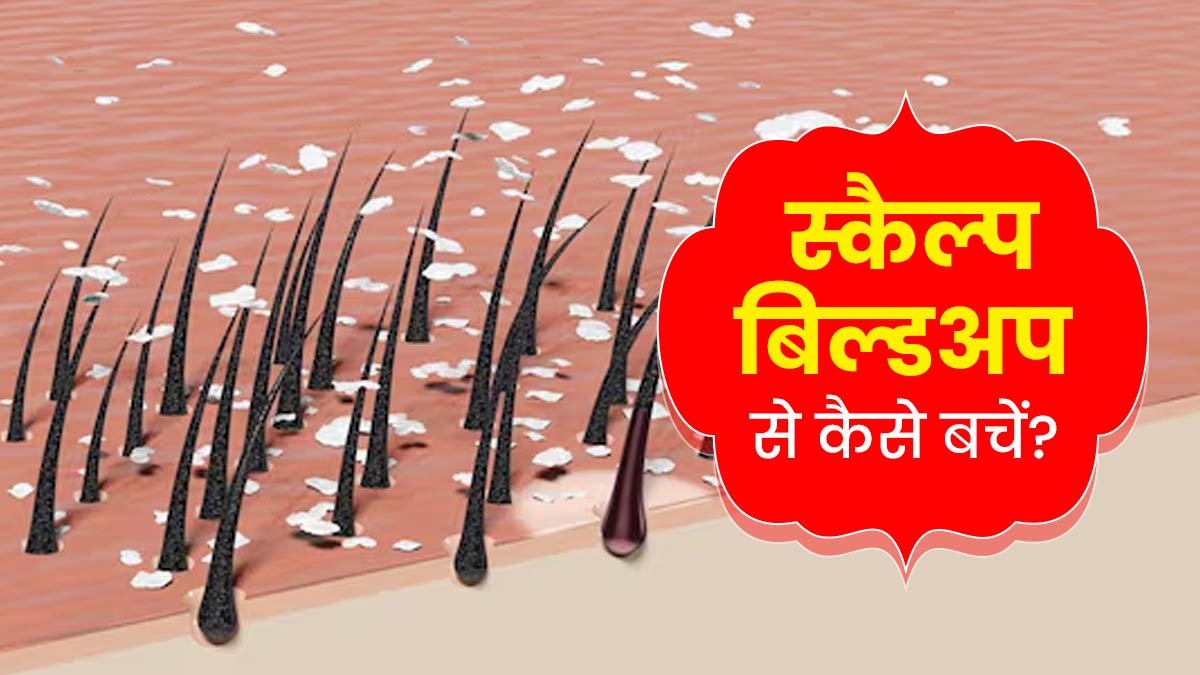 स्कैल्प पर शैंपू जमने की वजह से हो गया है डैंड्रफ और हेयर फॉल, बचाव के लिए अपनाएं ये 5 तरीके