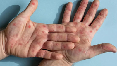 केंद्रीय स्वास्थ्य मंत्रालय Mpox की स्क्रीनिंग और टेस्टिंग पर दे रहा है जोर, जारी की गईं गाइडलाइंस 