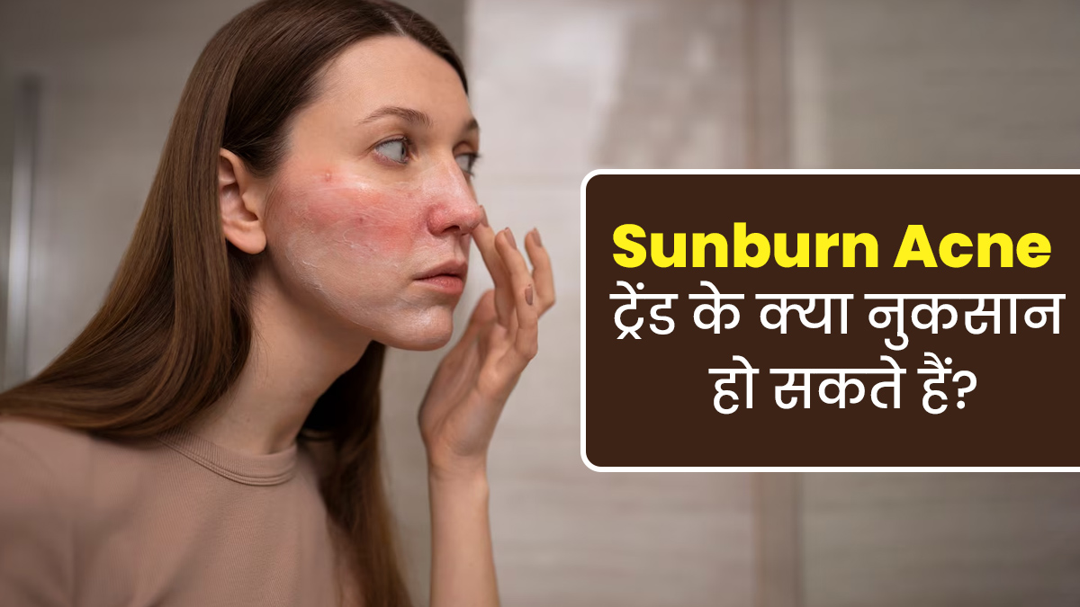 क्या है सनबर्निंग एक्ने ट्रेंड? जानें इसे फॉलो करने से त्वचा को होने वाले नुकसान