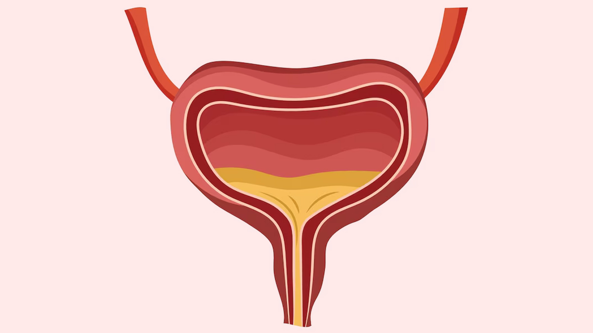Overactive bladder