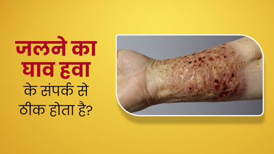 जल गई है त्वचा? जानें क्या वाकई घाव को खुला रखने से मिलता है फायदा