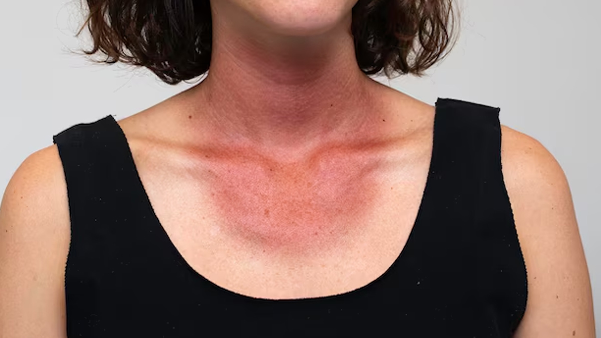 burnt skin treatment