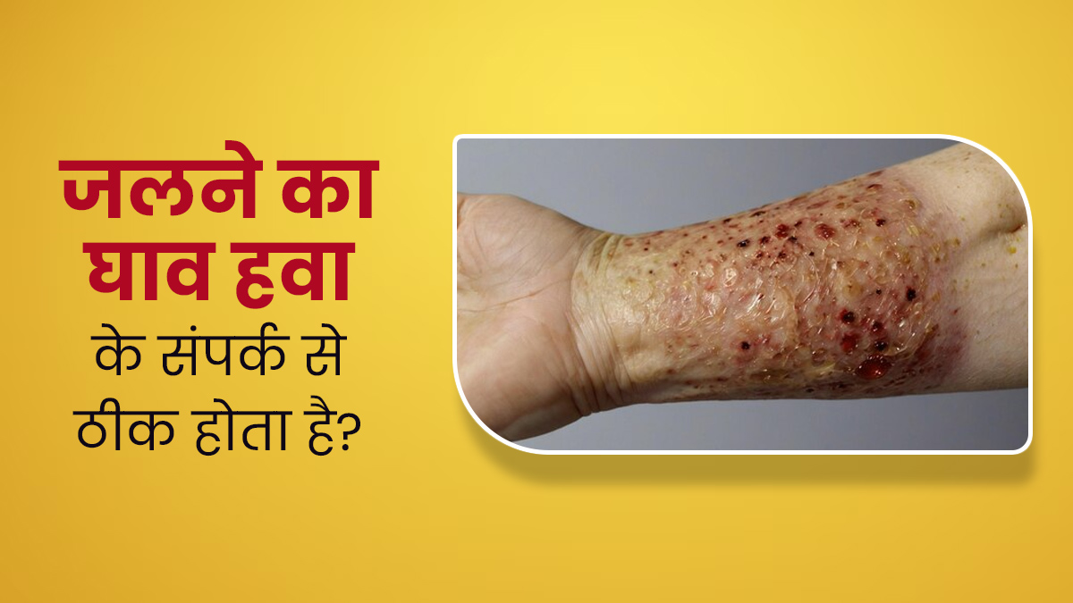 जल गई है त्वचा? जानें क्या वाकई घाव को खुला रखने से मिलता है फायदा