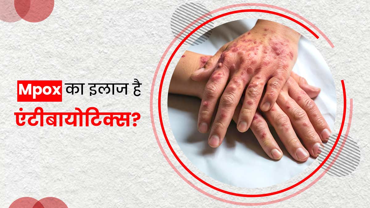 क्‍या एमपॉक्स का इलाज एंटीबायोट‍िक्‍स के जर‍िए संभव है? डॉक्‍टर से जानें 