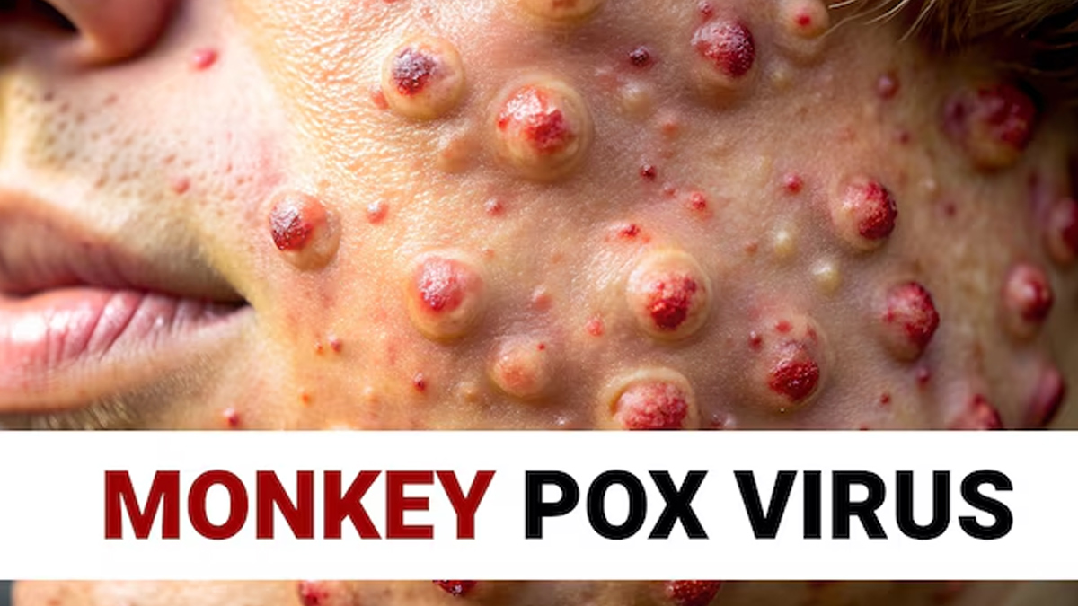 can mpox be cured with antibiotics