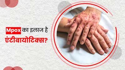 क्‍या एमपॉक्स का इलाज एंटीबायोट‍िक्‍स के जर‍िए संभव है? डॉक्‍टर से जानें 