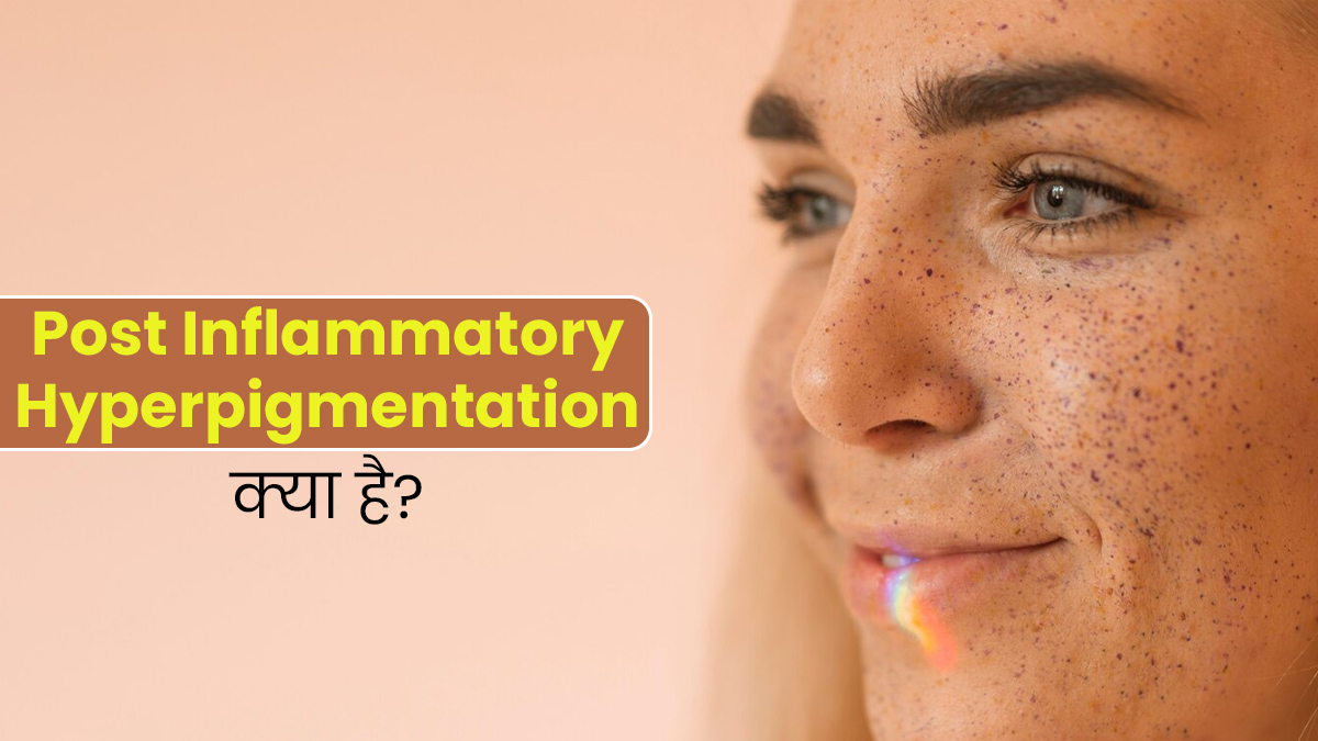 चेहरे की खूबसूरती खराब कर सकता है पोस्ट-इंफ्लेमेटरी हाइपरपिग्मेंटेशन (PIH), जानें क्या है यह समस्या?