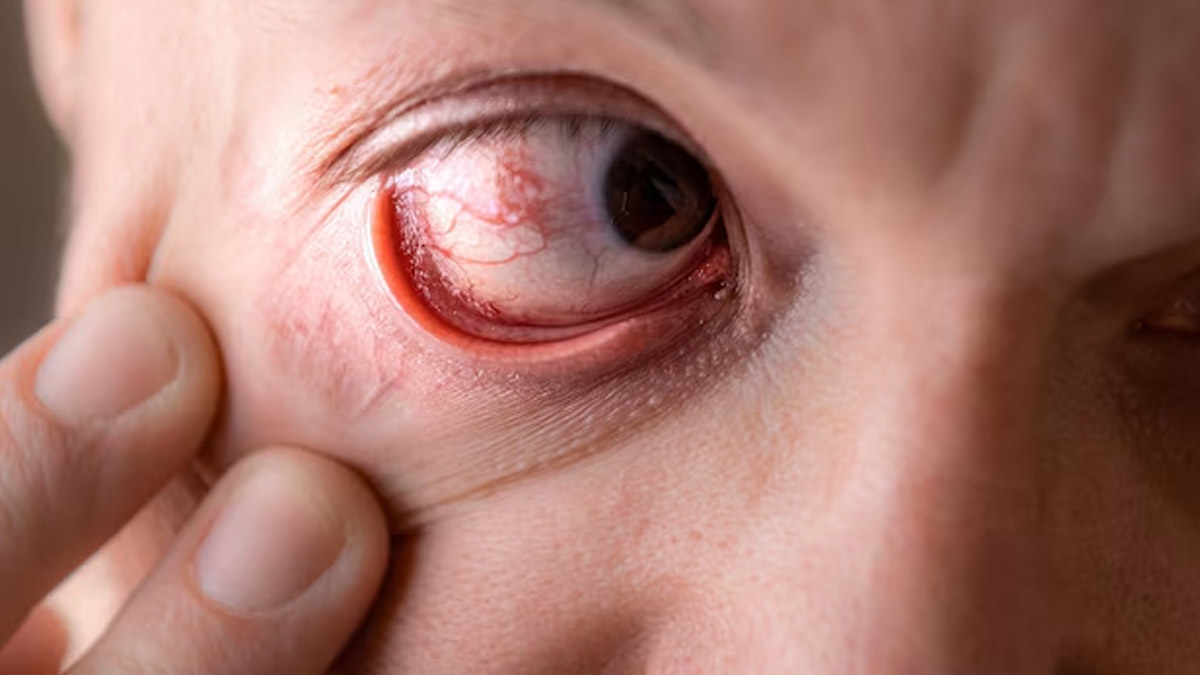 Eye Discolouration: Expert Reveals What Your Eyes May Be Telling You About Your Health