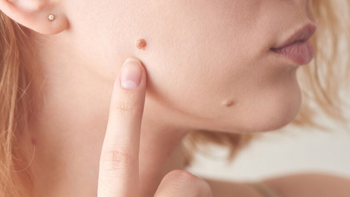 How Can You Treat Warts Naturally At Home