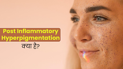 चेहरे की खूबसूरती खराब कर सकता है पोस्ट-इंफ्लेमेटरी हाइपरपिग्मेंटेशन (PIH), जानें क्या है यह समस्या?