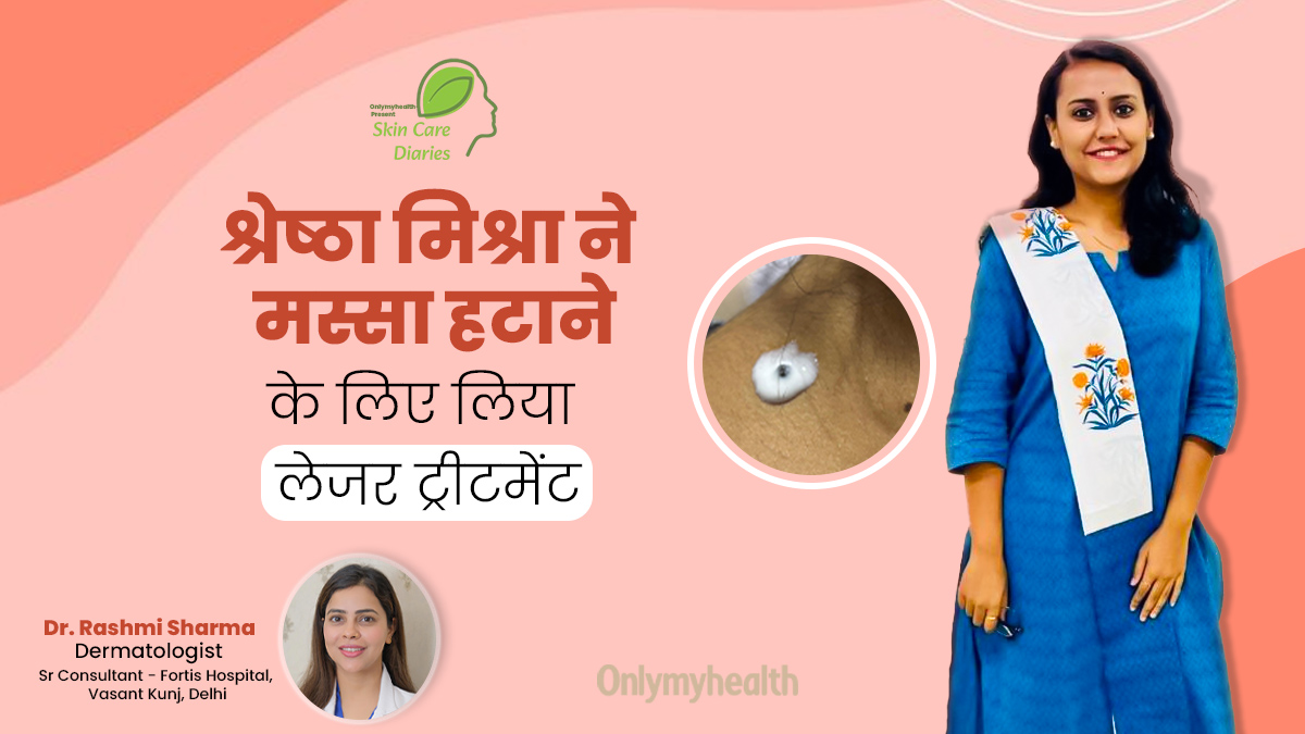गर्दन से मस्सा हटाने के लिए श्रेष्ठा मिश्रा ने लिया लेजर ट्रीटमेंट, जानें कितनी कारगर है यह प्रक्रिया
