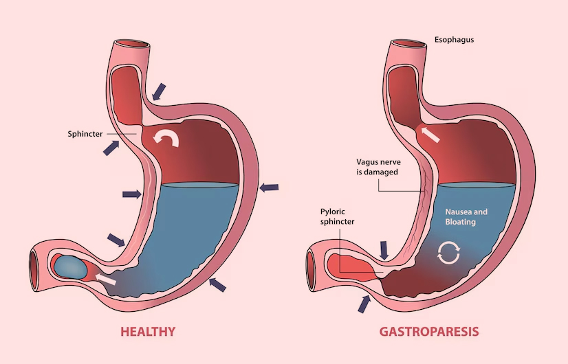 Gastroparesis