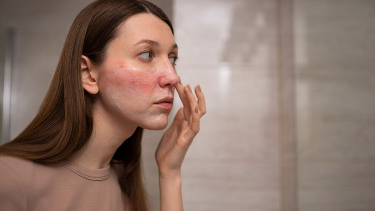 Face Rash: 5 Home Remedies To Manage The Skin Condition