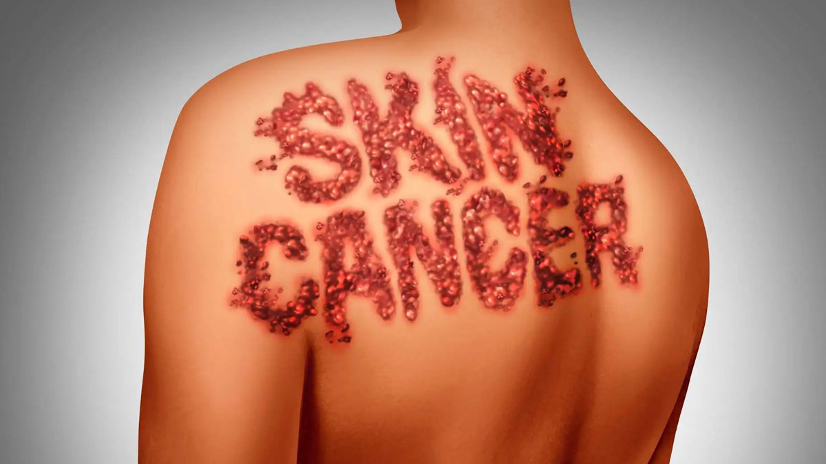 Study Finds Decline In Skin Cancer Rates Among Young Adults | OnlyMyHealth