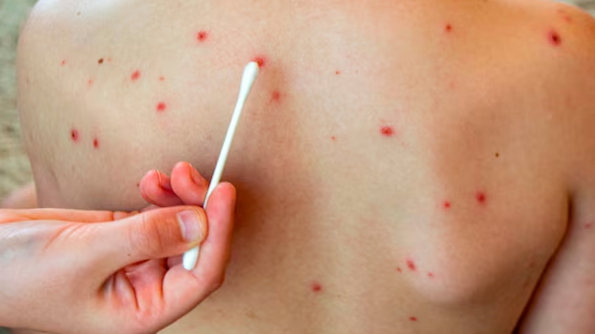 Mpox Myths And Facts In Hindi