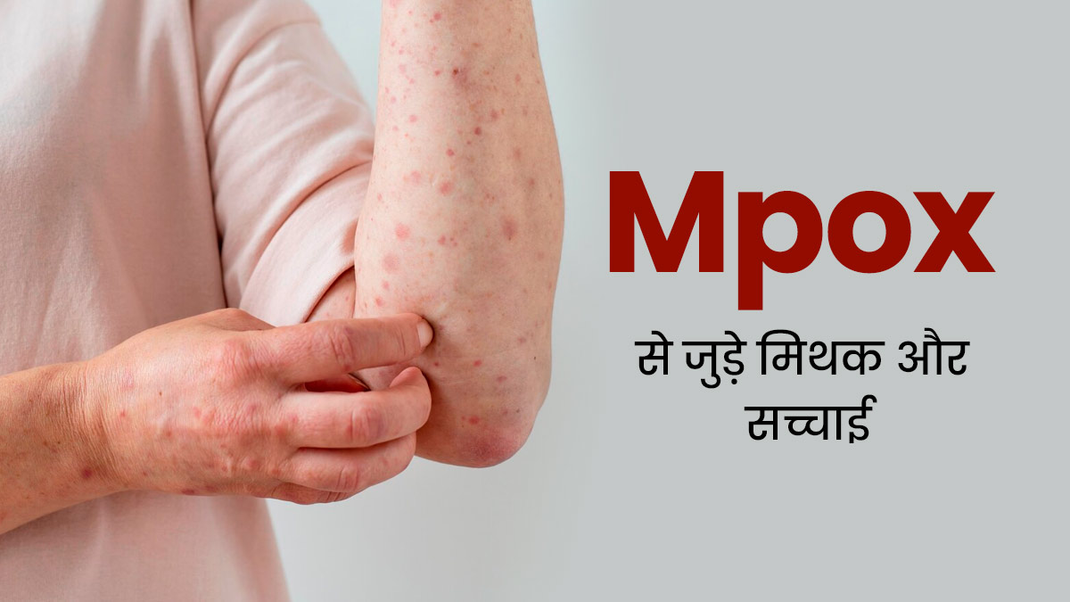 Mpox से जुड़े इन 5 मिथकों पर लोग कर रहे हैं यकीन, जानें क्या हैं इनकी सच्चाई 